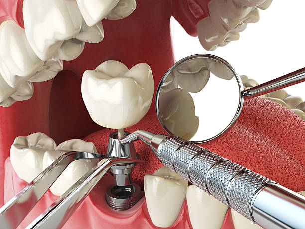 Best Emergency Root Canal Treatment in Fairmount, IN